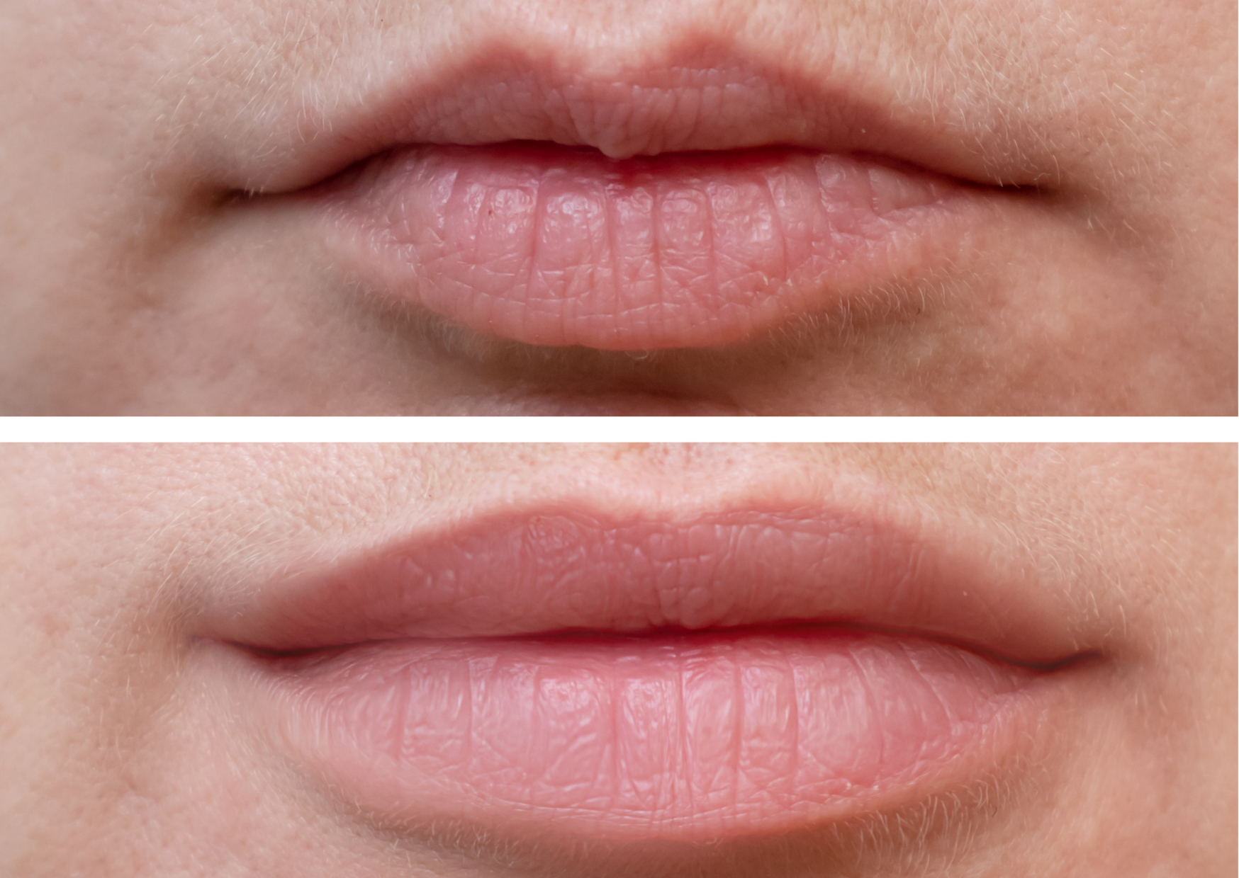 Lip-Fillers-Before-After1
