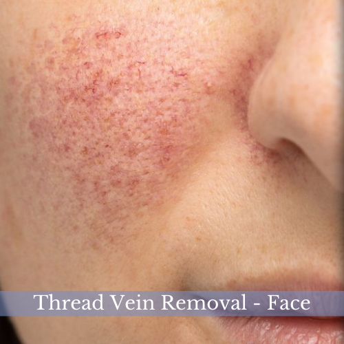 Portfolio - Dermatology - Thread Vein Removal Face