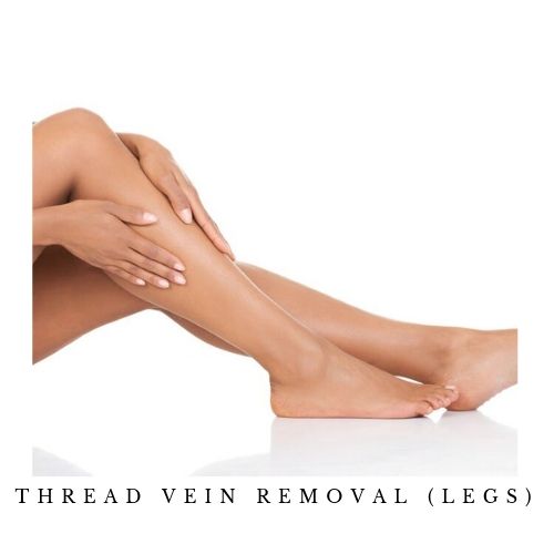 thread-vein-removal-legs
