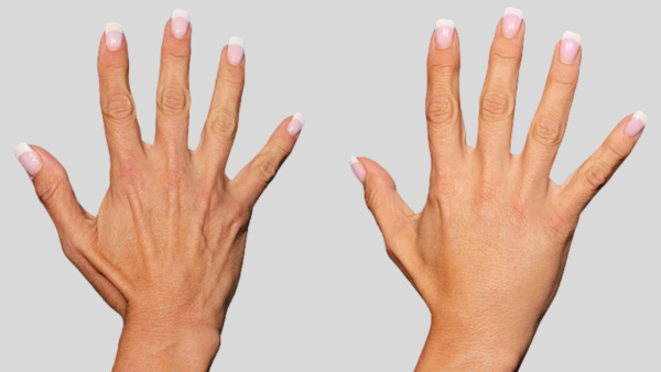 hands-wrinkles-Before-After1