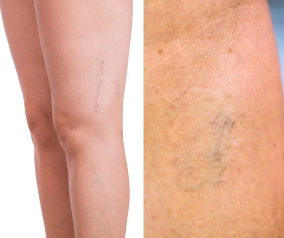  microsclerotherapy-website