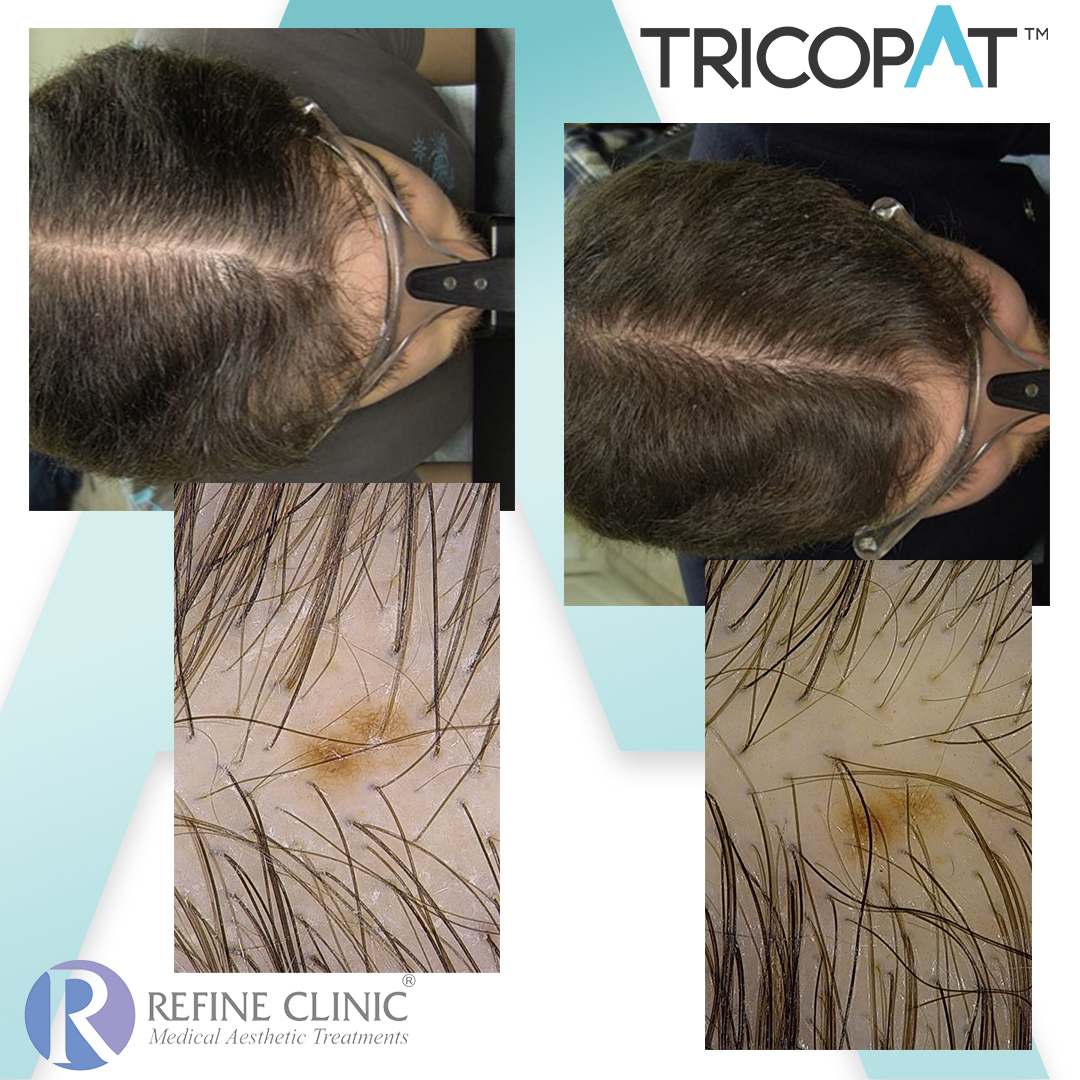 Tricopat-Before-And-After-2