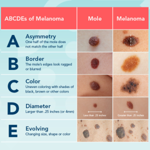 moles-and-melanoma